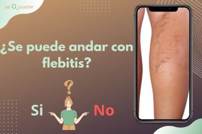 ¿Se puede andar con flebitis?